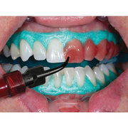 Ultradent Opalescence Boost Pf 40% Plus Mini Kit